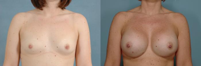 Before & After Breast Augmentation Case 747 Front View in Tallahassee, FL