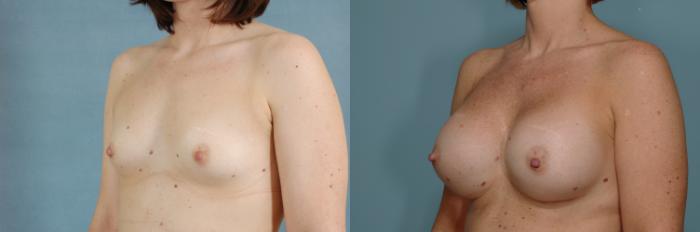 Before & After Breast Augmentation Case 747 Left Oblique View in Tallahassee, FL