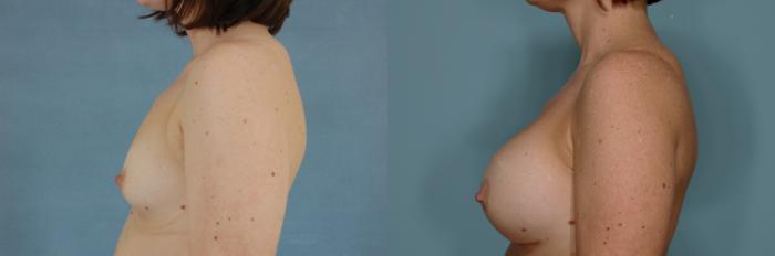 Before & After Breast Augmentation Case 747 Left Side View in Tallahassee, FL