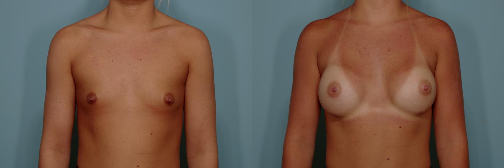 Before & After Breast Augmentation Case 765 Front View in Tallahassee, FL