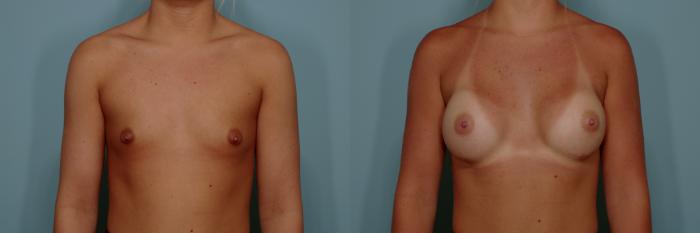 Before & After Breast Augmentation Case 765 Front View in Tallahassee, FL