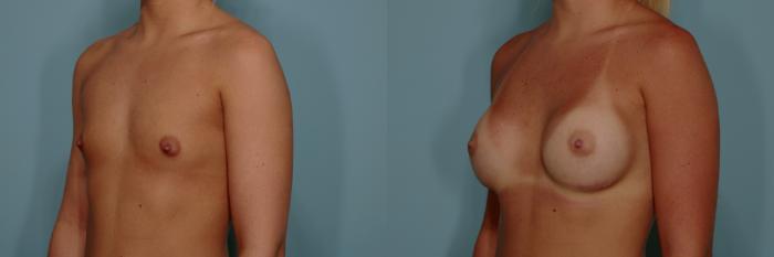 Before & After Breast Augmentation Case 765 Left Oblique View in Tallahassee, FL