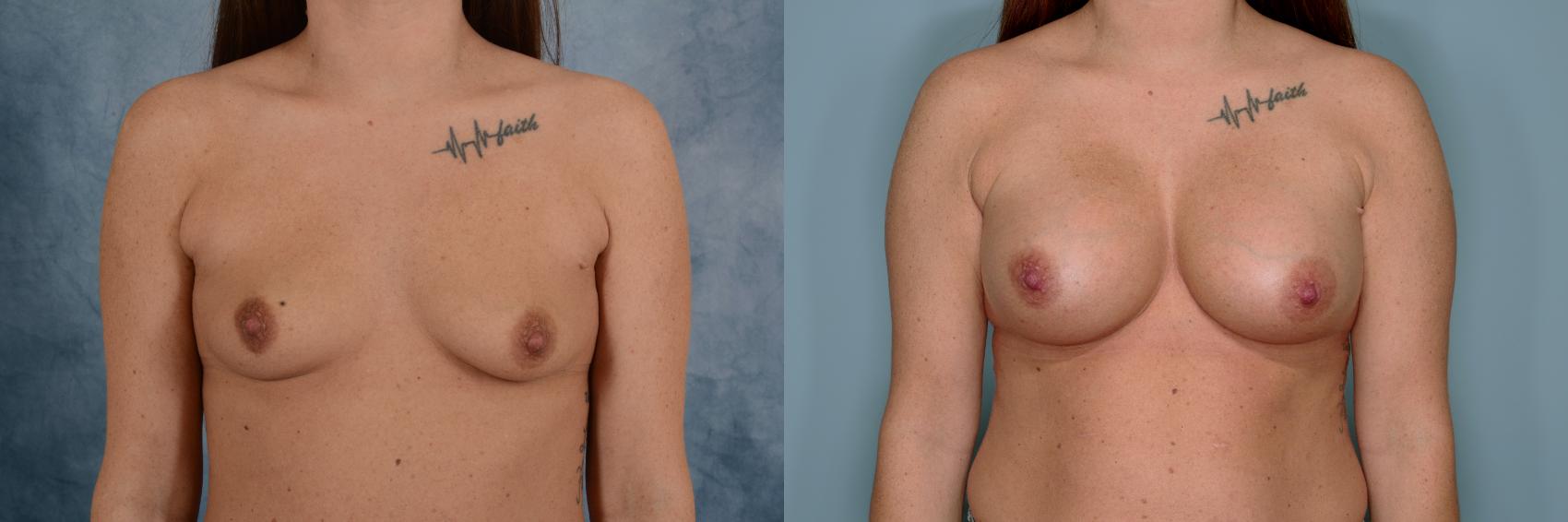 Before & After Breast Augmentation Case 768 Front View in Tallahassee, FL