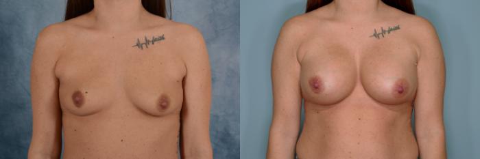 Before & After Breast Augmentation Case 768 Front View in Tallahassee, FL