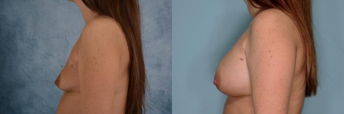 Before & After Breast Augmentation Case 768 Left Side View in Tallahassee, FL