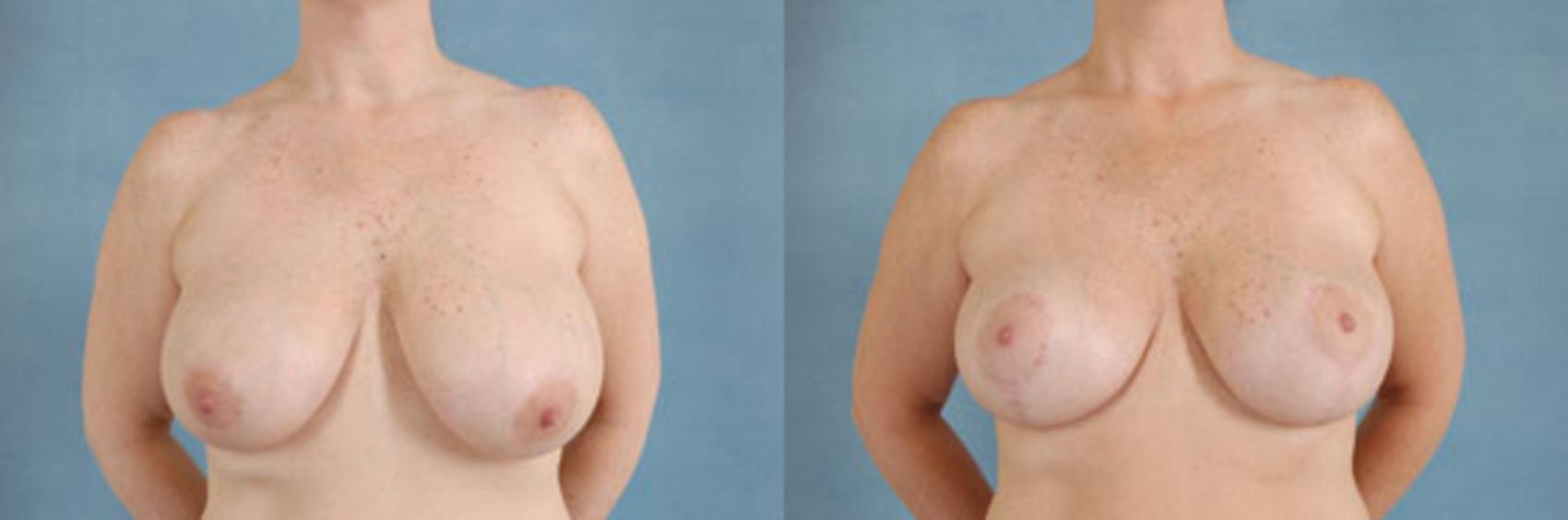 Before & After Breast Lift Case 137 View #1 View in Tallahassee, FL