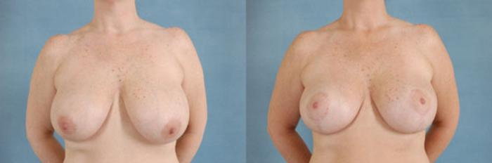 Before & After Breast Lift Case 137 View #1 View in Tallahassee, FL