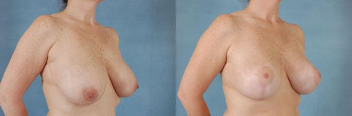 Before & After Breast Lift Case 137 View #2 View in Tallahassee, FL