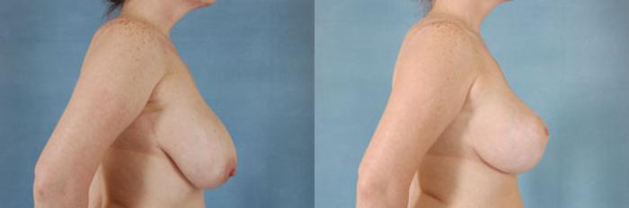 Before & After Breast Lift Case 137 View #3 View in Tallahassee, FL