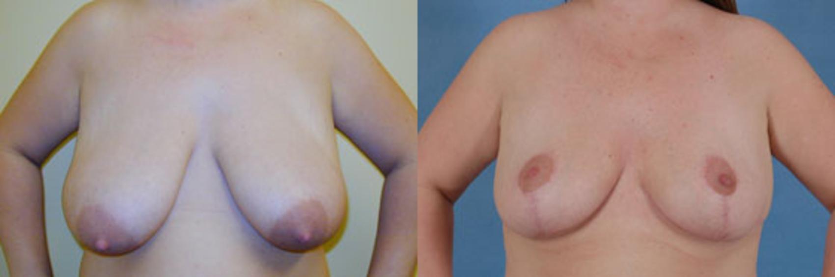 Before & After Breast Lift Case 138 View #1 View in Tallahassee, FL