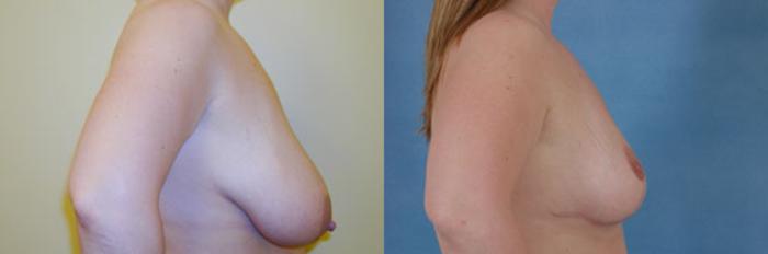 Before & After Breast Lift Case 138 View #2 View in Tallahassee, FL