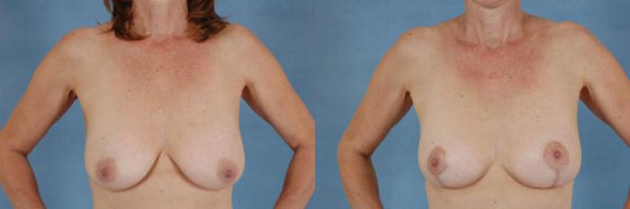Before & After Breast Lift Case 139 View #1 View in Tallahassee, FL