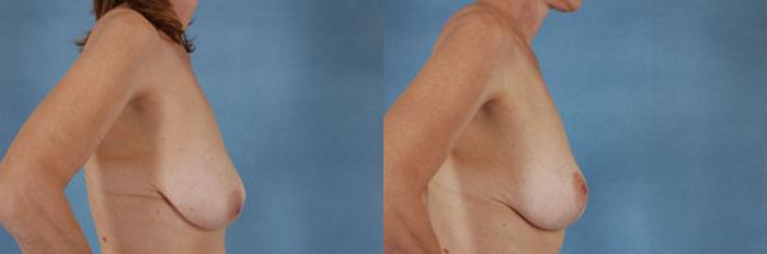 Before & After Breast Lift Case 139 View #2 View in Tallahassee, FL