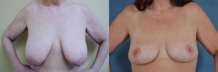 Before & After Breast Lift Case 140 View #1 View in Tallahassee, FL