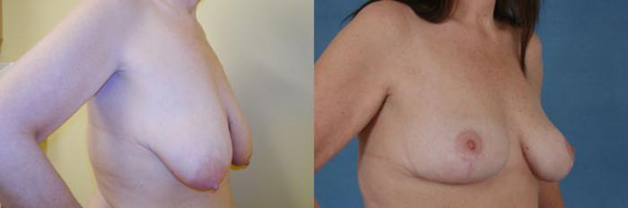 Before & After Breast Lift Case 140 View #2 View in Tallahassee, FL