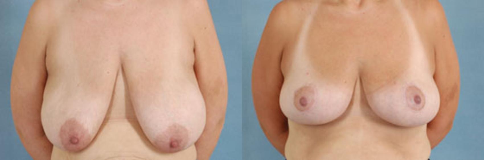 Before & After Breast Lift Case 141 View #1 View in Tallahassee, FL