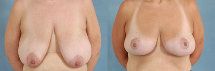 Before & After Breast Lift Case 141 View #1 View in Tallahassee, FL
