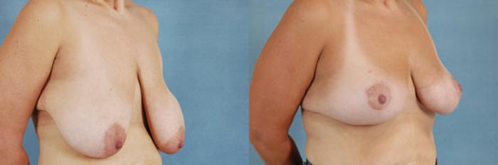 Before & After Breast Lift Case 141 View #2 View in Tallahassee, FL