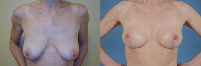 Before & After Breast Lift Case 142 View #1 View in Tallahassee, FL