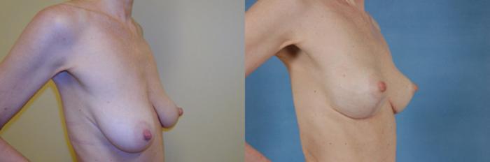 Before & After Breast Lift Case 142 View #2 View in Tallahassee, FL
