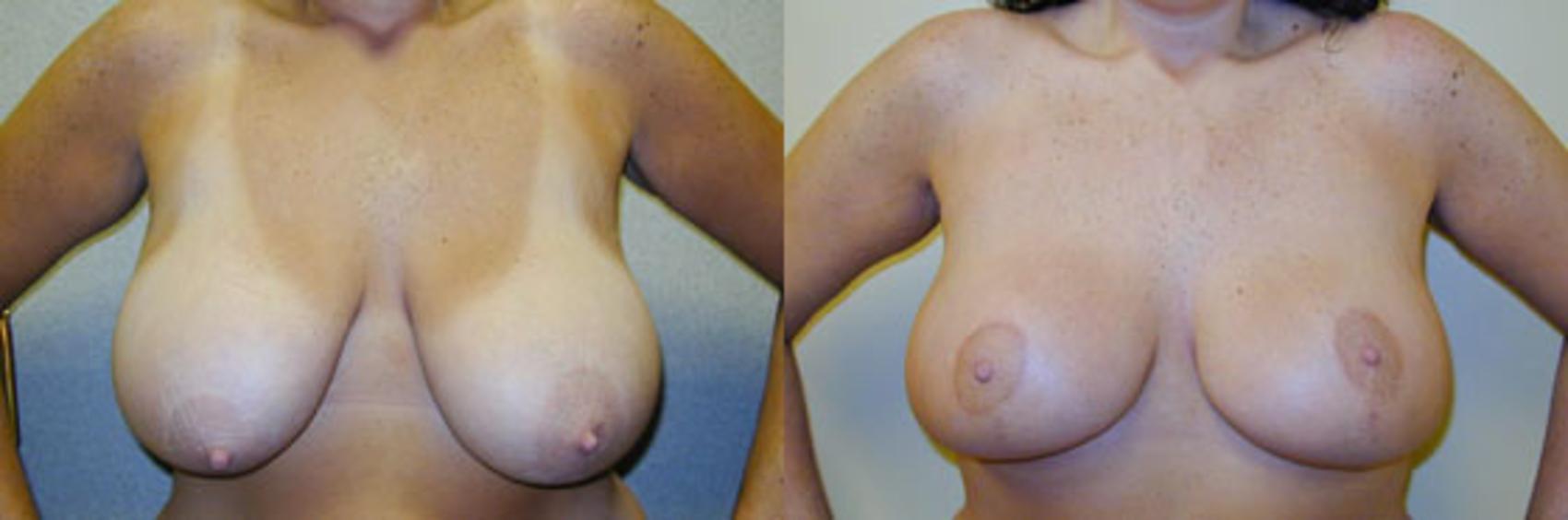 Before & After Breast Lift Case 143 View #1 View in Tallahassee, FL