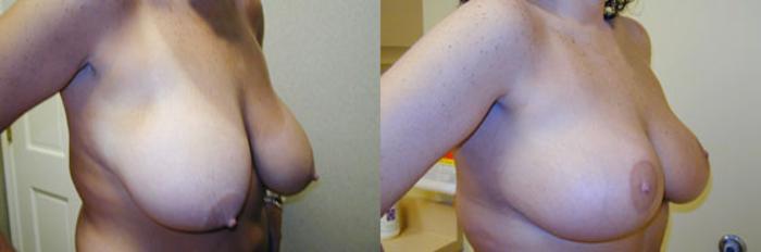 Before & After Breast Lift Case 143 View #2 View in Tallahassee, FL