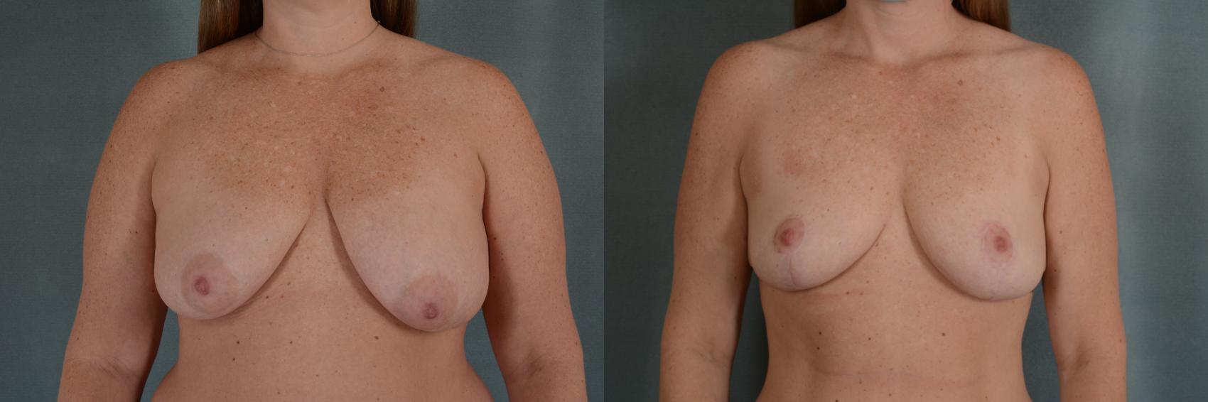 Before & After Breast Lift Case 333 View #1 View in Tallahassee, FL