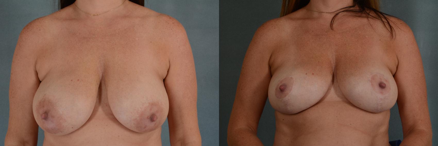 Before & After Breast Lift Case 354 View #1 View in Tallahassee, FL