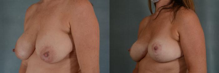 Before & After Breast Lift Case 354 View #2 View in Tallahassee, FL