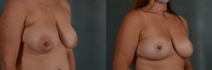 Before & After Breast Lift Case 354 View #3 View in Tallahassee, FL