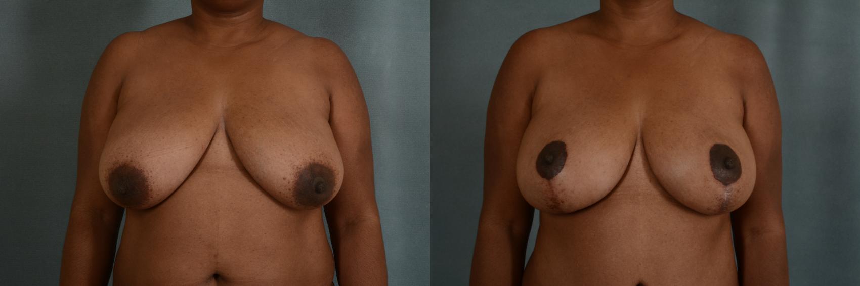 Before & After Breast Lift Case 359 View #1 View in Tallahassee, FL