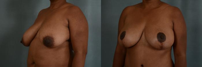 Before & After Breast Lift Case 359 View #2 View in Tallahassee, FL