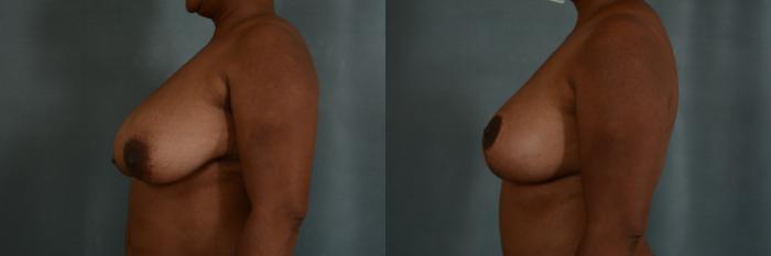 Before & After Breast Lift Case 359 View #3 View in Tallahassee, FL