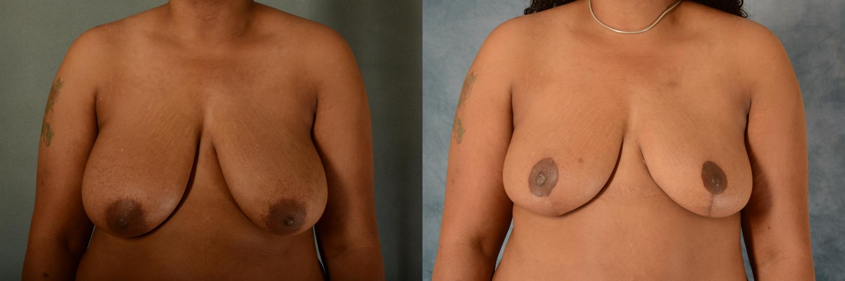 Before & After Breast Lift Case 514 Front View in Tallahassee, FL
