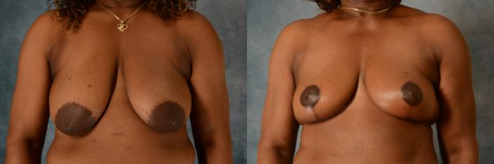 Before & After Breast Lift Case 540 Front View in Tallahassee, FL