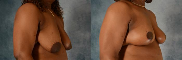 Before & After Breast Lift Case 540 Right Oblique View in Tallahassee, FL