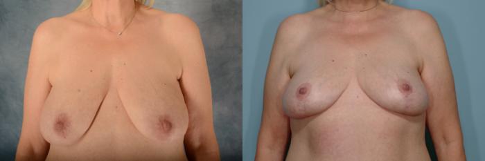 Before & After Breast Lift Case 689 Front View in Tallahassee, FL