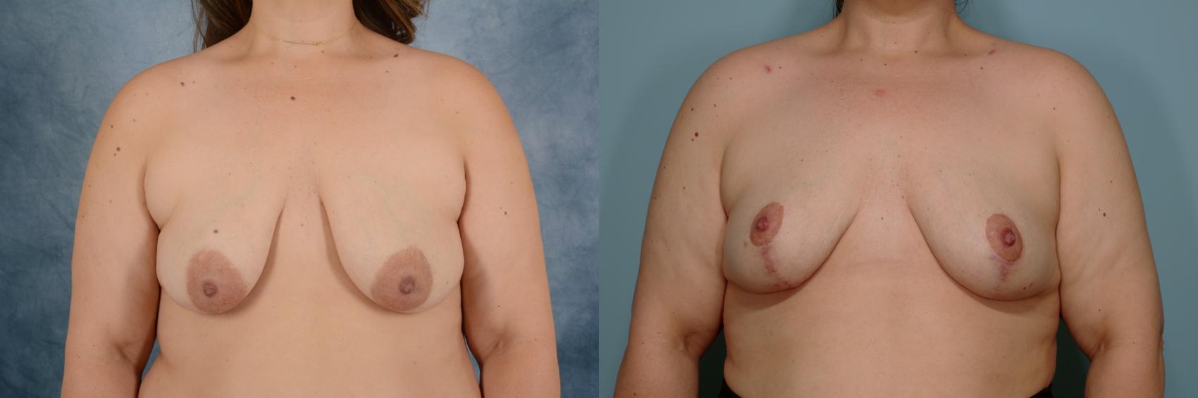 Before & After Breast Lift Case 754 Front View in Tallahassee, FL