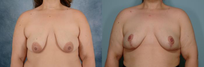 Before & After Breast Lift Case 754 Front View in Tallahassee, FL