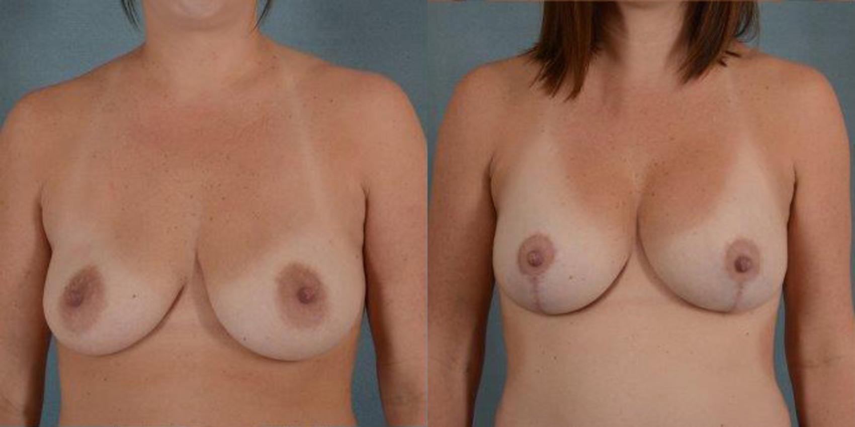 Before & After Breast Lift (Mastopexy) with Implants Case 215 View #1 View in Tallahassee, FL