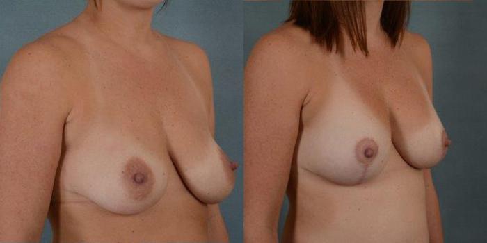 Before & After Breast Lift (Mastopexy) with Implants Case 215 View #2 View in Tallahassee, FL