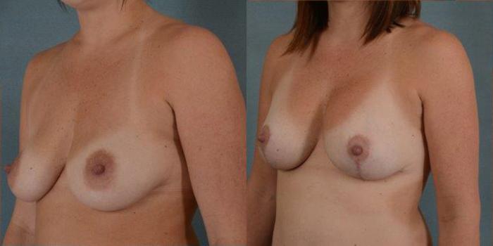 Before & After Breast Lift (Mastopexy) with Implants Case 215 View #3 View in Tallahassee, FL