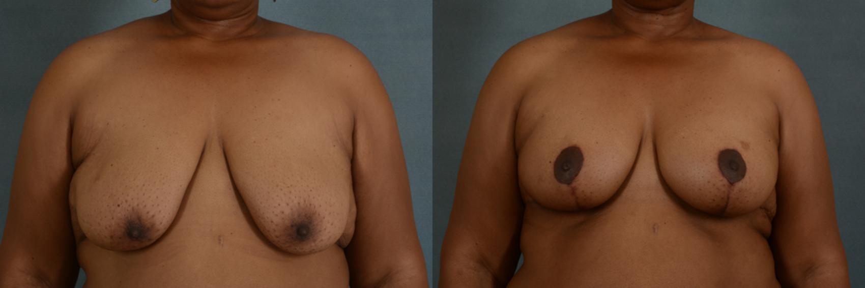 Before & After Breast Lift (Mastopexy) with Implants Case 216 View #1 View in Tallahassee, FL