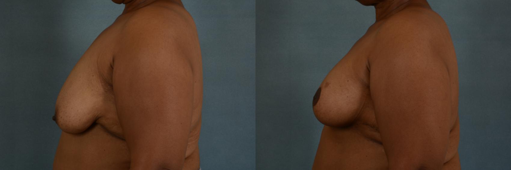 Before & After Breast Lift (Mastopexy) with Implants Case 216 View #2 View in Tallahassee, FL