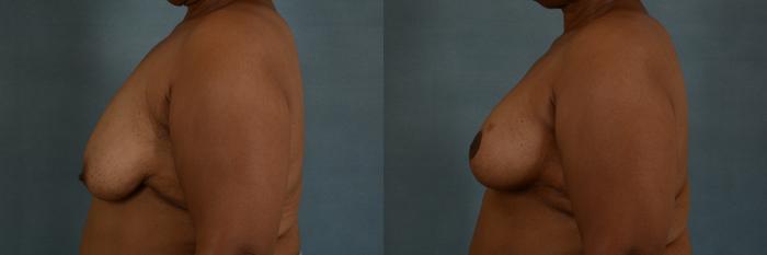 Before & After Breast Lift (Mastopexy) with Implants Case 216 View #2 View in Tallahassee, FL