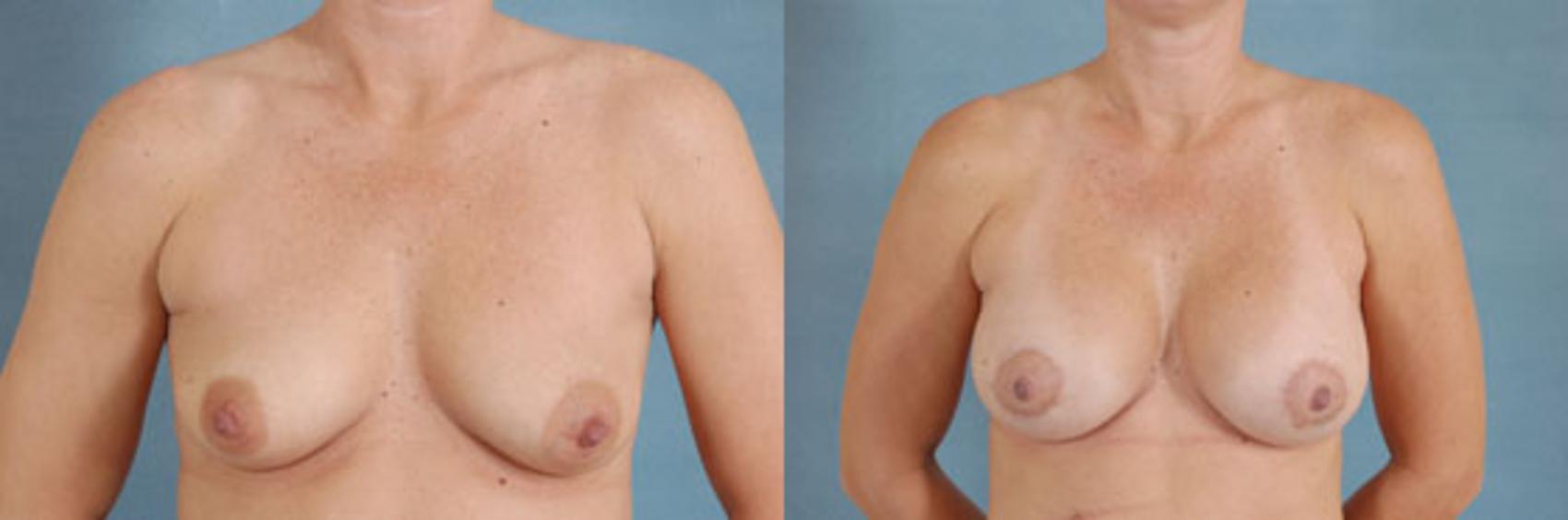 Before & After Breast Lift (Mastopexy) with Implants Case 217 View #1 View in Tallahassee, FL