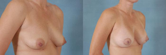Before & After Breast Lift (Mastopexy) with Implants Case 217 View #2 View in Tallahassee, FL
