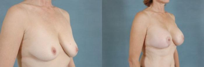 Before & After Breast Lift (Mastopexy) with Implants Case 219 View #2 View in Tallahassee, FL