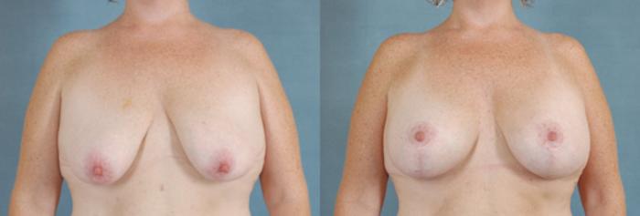 Before & After Breast Lift (Mastopexy) with Implants Case 220 View #1 View in Tallahassee, FL