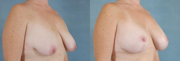 Before & After Breast Lift (Mastopexy) with Implants Case 220 View #2 View in Tallahassee, FL